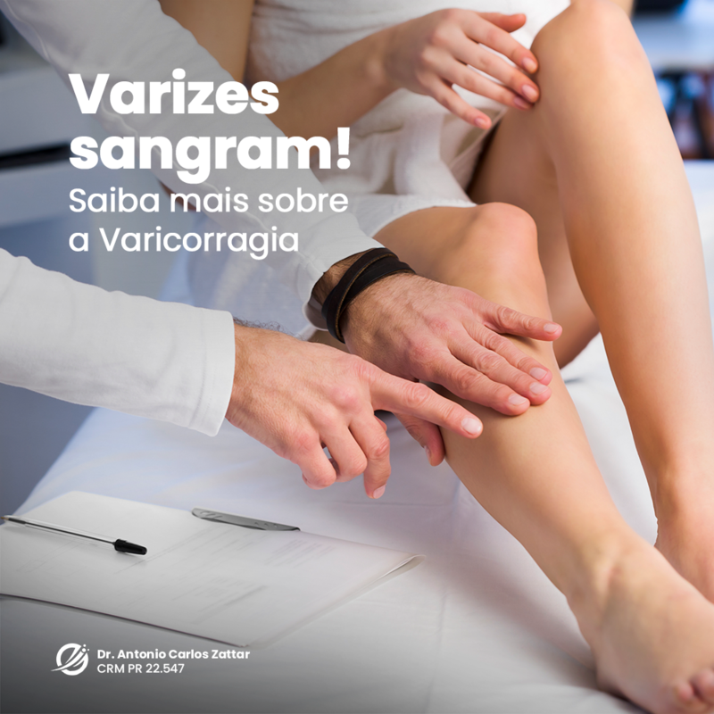 Varizes sangram? Entenda a Varicorragia 